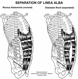 Diastasis20recti.gif