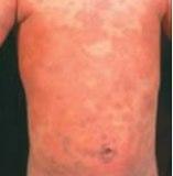 Urticaria.jpg